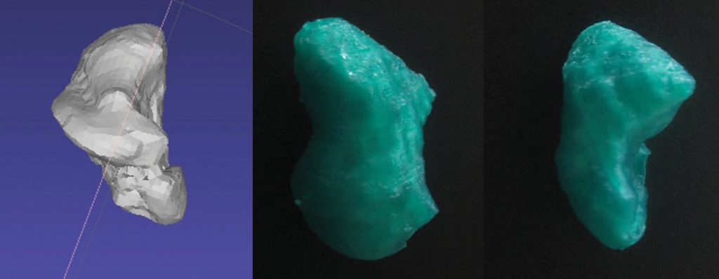 Scaphoid bone
